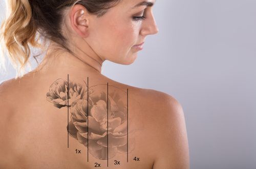 Laser Tattoo Removal On Woman's Shoulder Against Gray Background